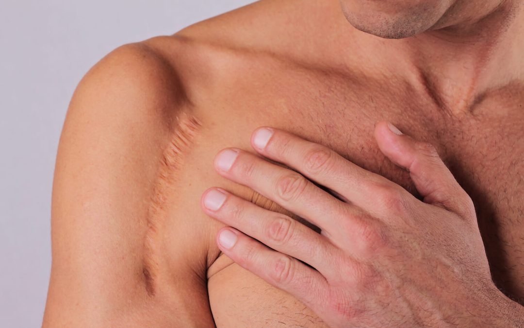 The Therapeutic Potential of Silicone Gel for Scar Tissue Management