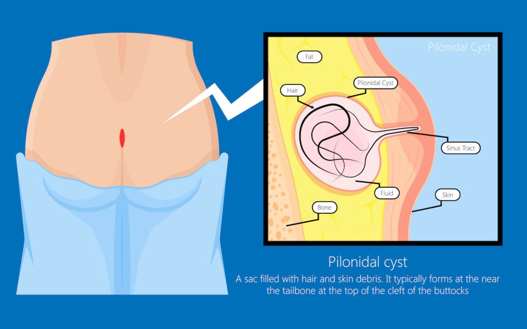 What You Need to Know About Pilonidal Cysts