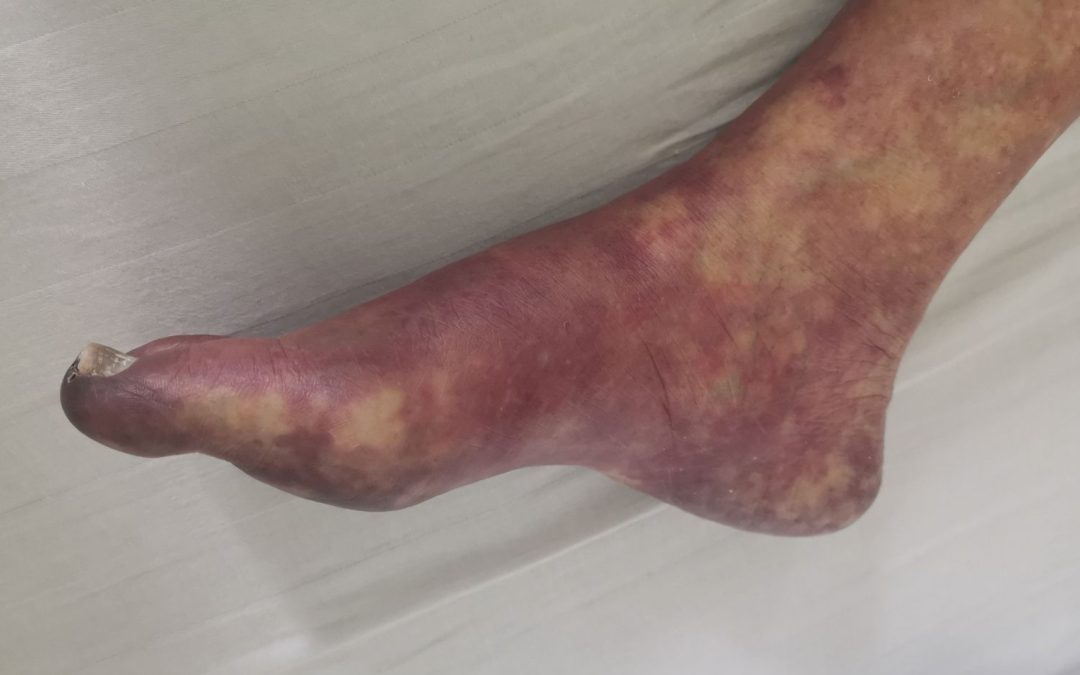 Chronic limb ischemia
