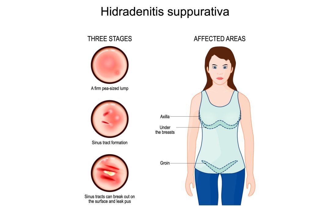 Hidradenitis suppurativa: new biological treatment