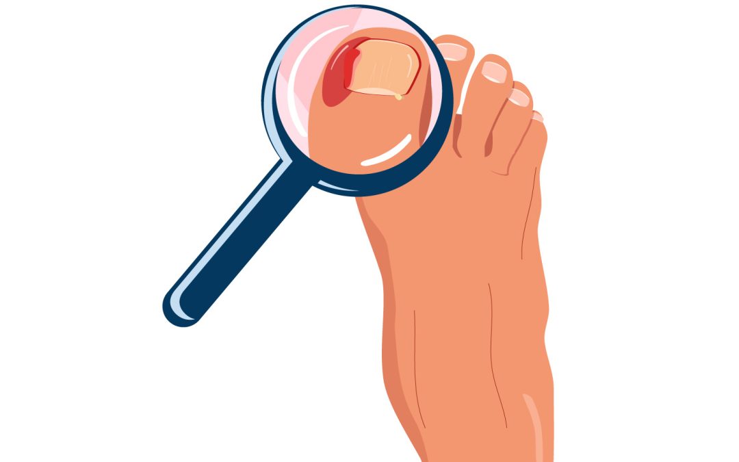 Hypergranulation Tissue and Wound Care