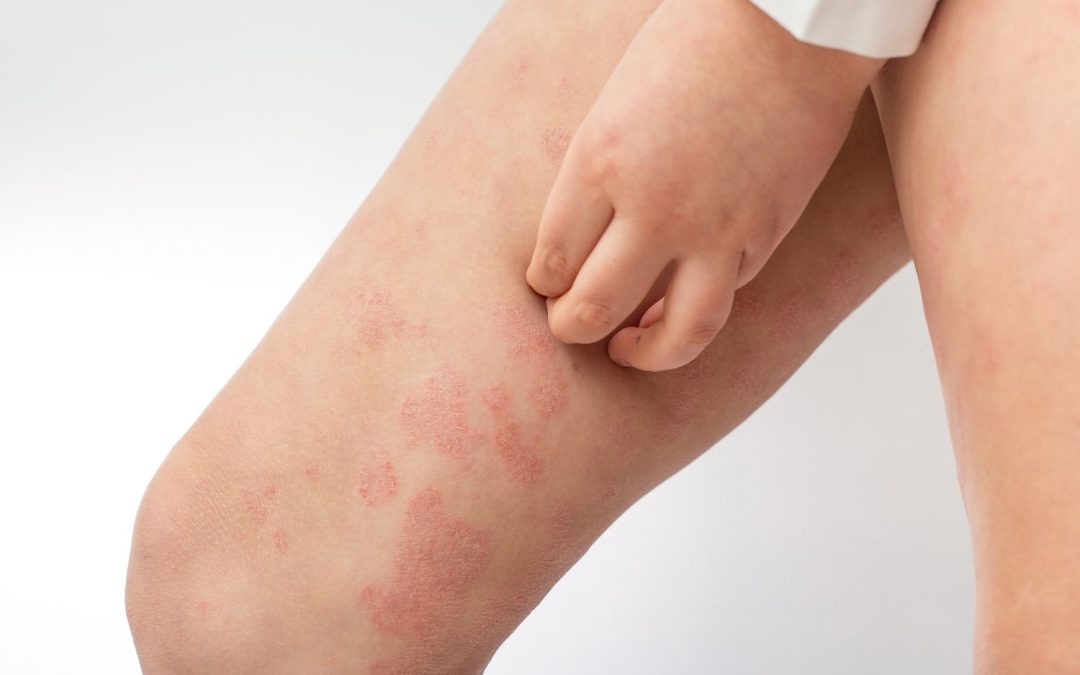 Incontinence and dermatitis