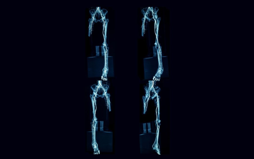 Lower Extremity Arterial Disease