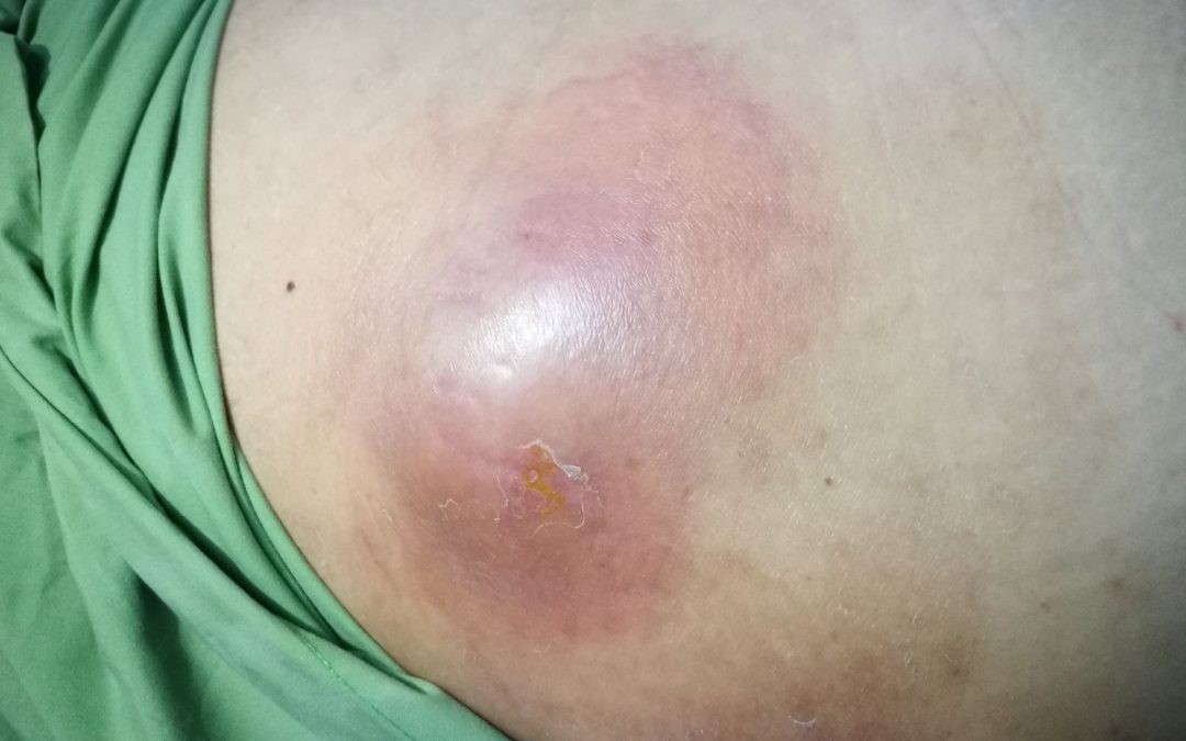 MRSA skin infection