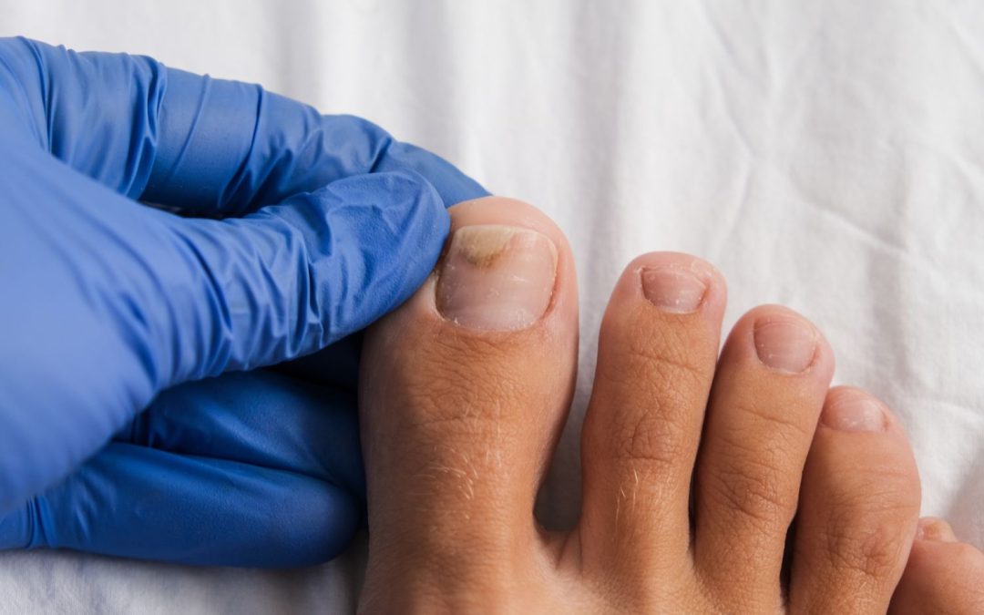 Nail Fungal infection