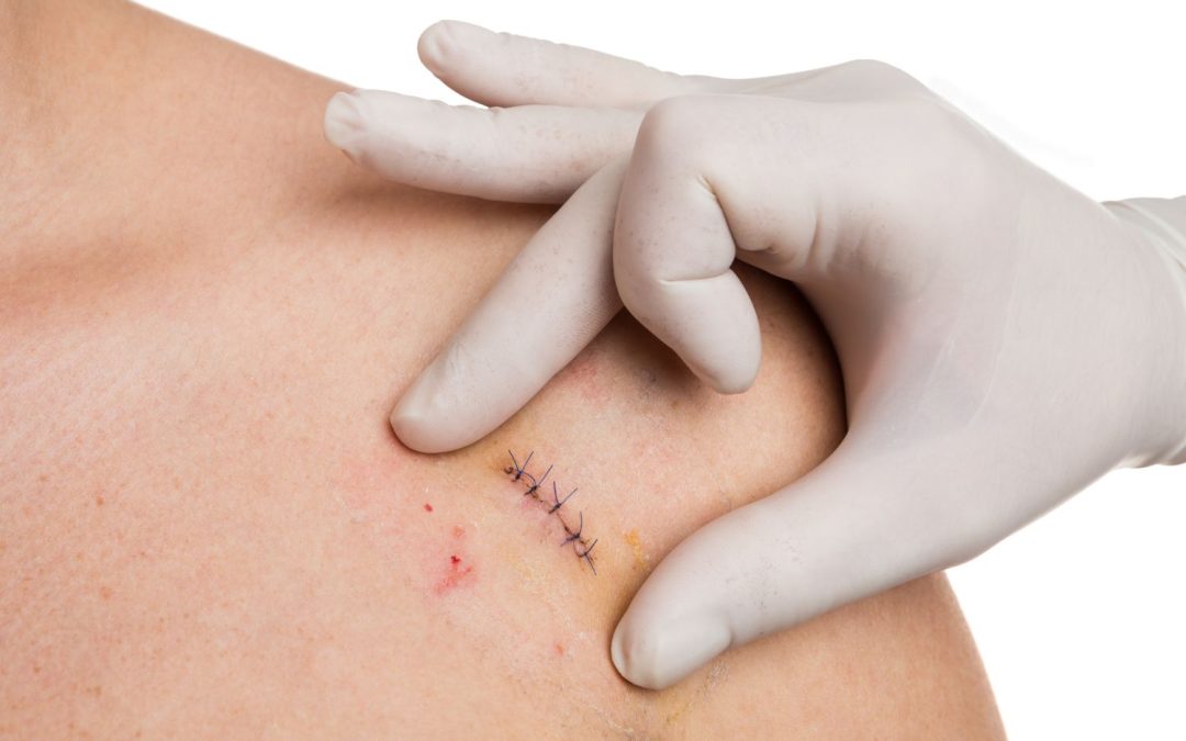 Preventing Surgical Site Infections in Abdominal Surgery