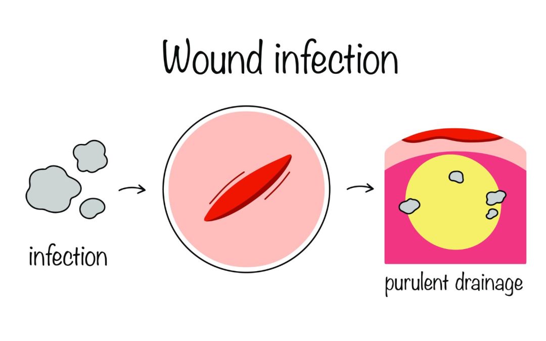 Signs and Symptoms of Wound Infection