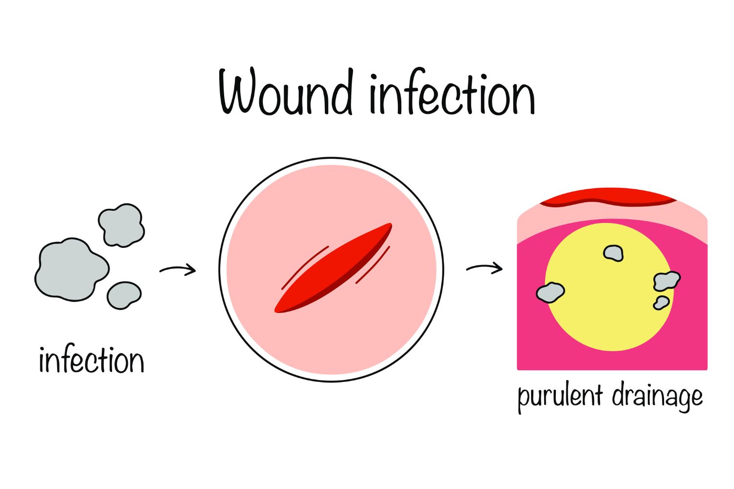 Signs and Symptoms of Wound Infection