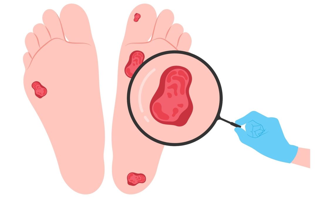 Diagnosis of Osteomyelitis in Diabetic Foot Ulcer