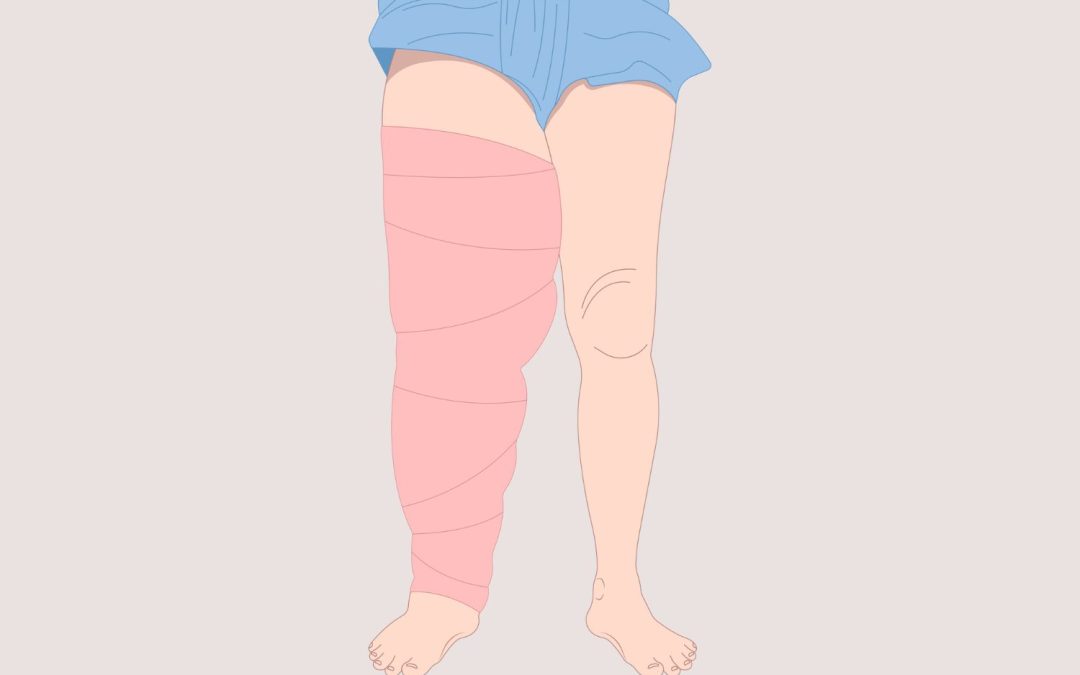 Compression Therapy for the Treatment of Wounds on the Lower Limb