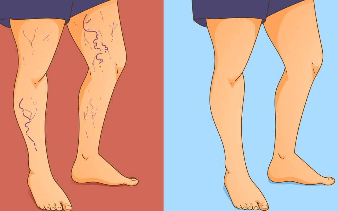 Prevention of Venous Leg Ulcer