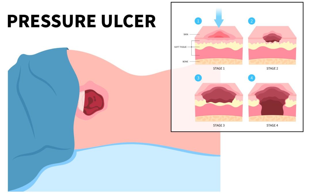Pressure injury. How to prevent and what use