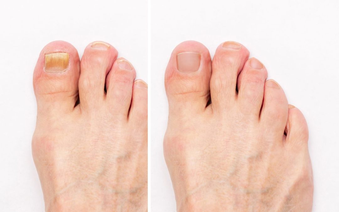 Fungal nail infection treatment